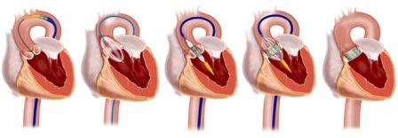 transfemoral-approach.jpg